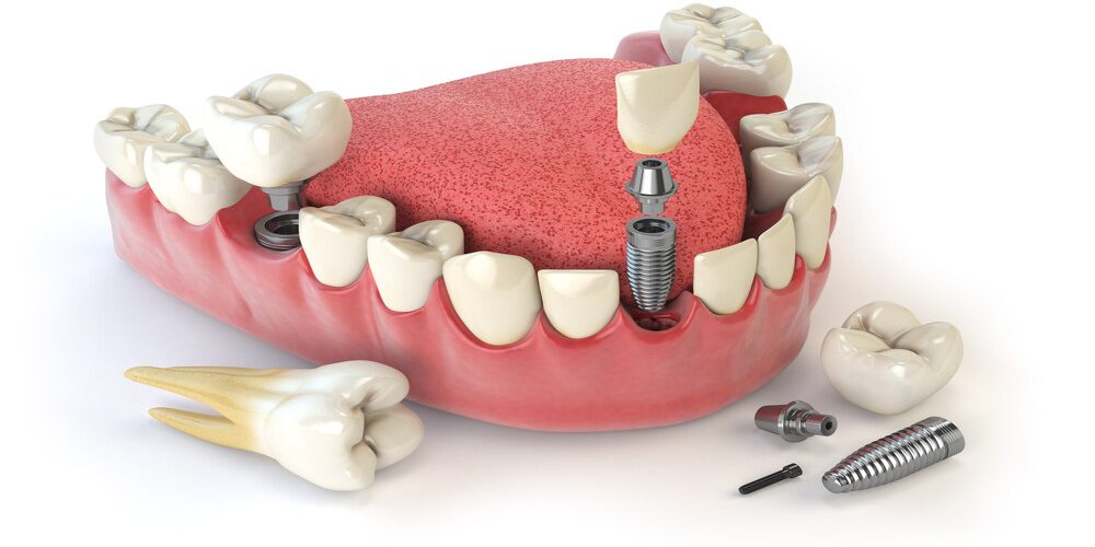 zirkonyum kırılırsa ne yapmalı