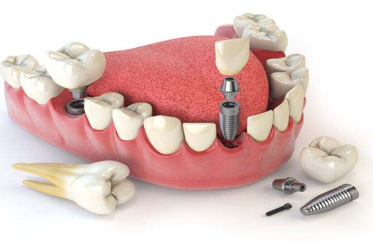 zirkonyum kırılırsa ne yapmalı