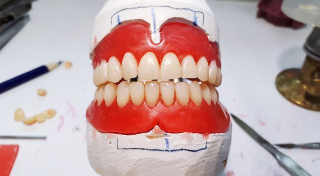 tam ağız implant