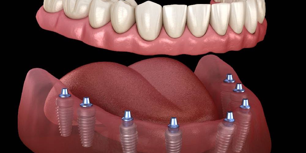 Hiç Dişi Olmayana Kaç İmplant Gerekir