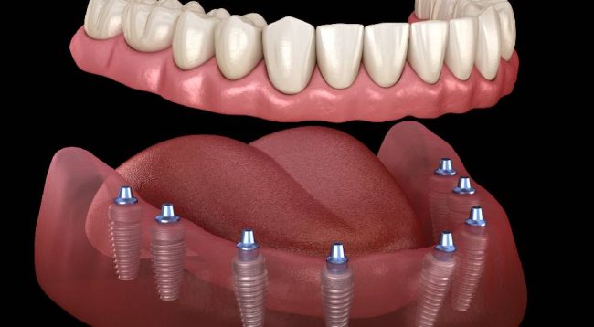 Hiç Dişi Olmayana Kaç İmplant Gerekir