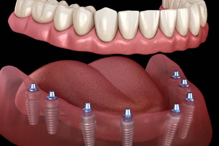 Hiç Dişi Olmayana Kaç İmplant Gerekir