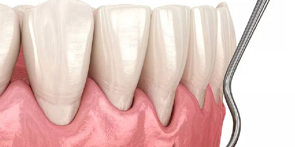 İmplant Sonrası Diş Eti Çekilmesi