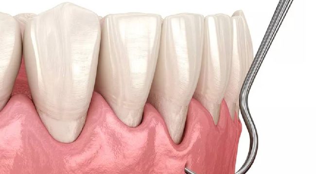 İmplant Sonrası Diş Eti Çekilmesi