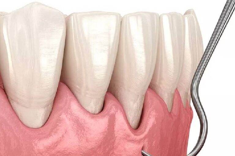 İmplant Sonrası Diş Eti Çekilmesi