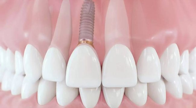 Ön Diş İmplant Tedavisi