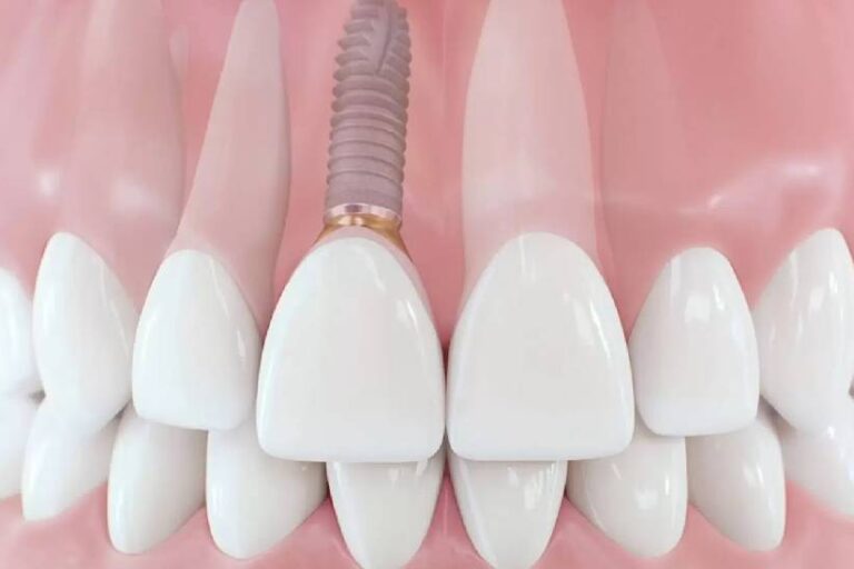 Ön Diş İmplant Tedavisi