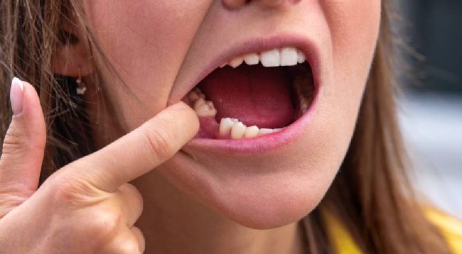 Eksik Diş Tedavisi