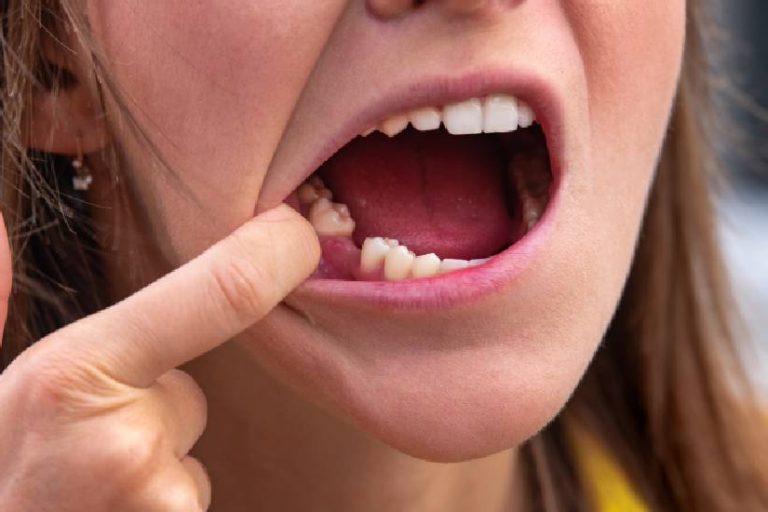 Eksik Diş Tedavisi