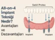 all on 4 implant tekniği nedir