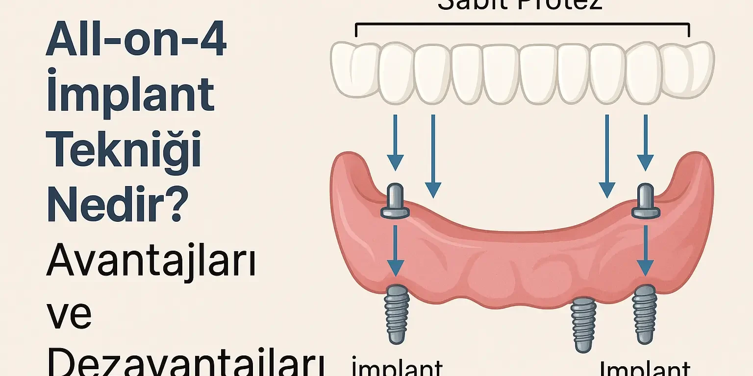 all-on-4-implant-teknigi-nedir-avantajlari-ve-dezavantajlari all on 4 implant tekniği nedir