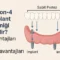 all on 4 implant tekniği nedir