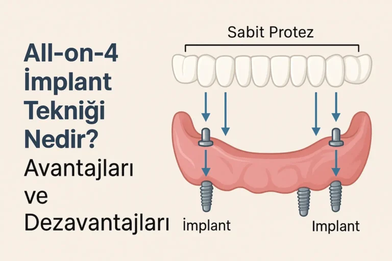 all on 4 implant tekniği nedir
