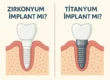 zirkonyum implant mı, titanyum implant mı