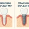 zirkonyum implant mı, titanyum implant mı