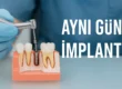 aynı gün implant immediate nedir