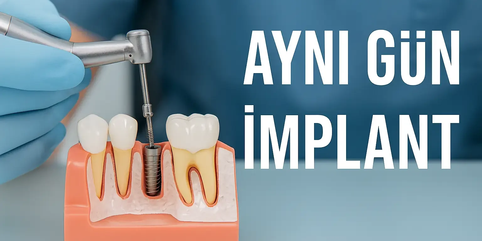 ayni-gun-implant-immediate-implant-nedir-avantajlari-ve-riskleri aynı gün implant immediate nedir