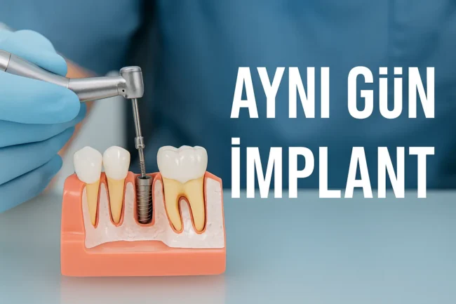 ayni-gun-implant-immediate-implant-nedir-avantajlari-ve-riskleri aynı gün implant immediate nedir