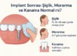implant sonrası şişlik, morarma ve kanama normal mi
