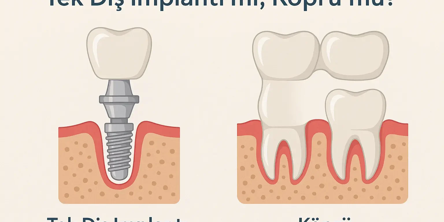 tek diş implantı mı yoksa köprü mü