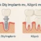 tek diş implantı mı yoksa köprü mü