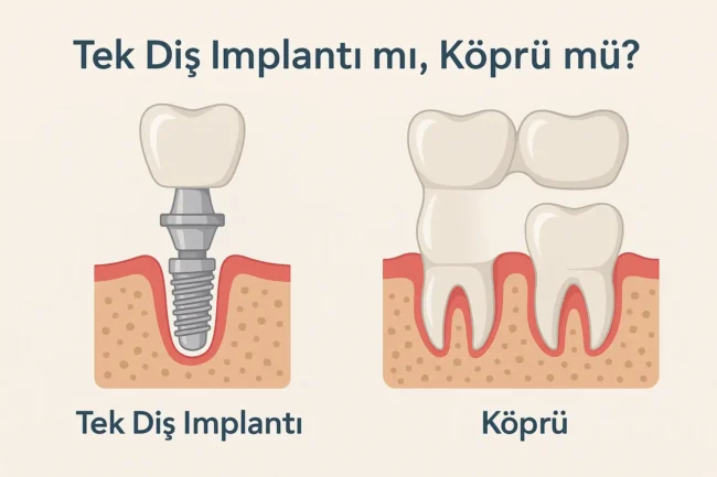 tek-dis-implanti-mi-kopru-mu-hangisi-daha-uygun tek diş implantı mı yoksa köprü mü
