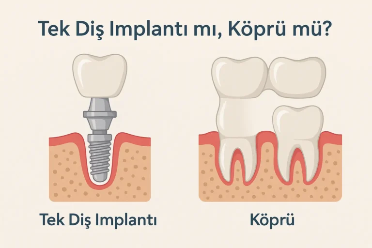 tek diş implantı mı yoksa köprü mü