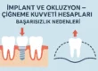 implant ve okluzyon çiğneme kuvveti hesapları, başarısızlık nedenleri