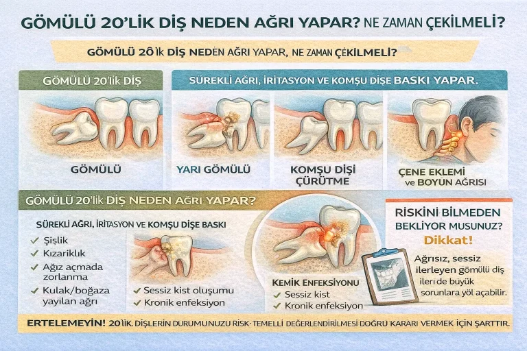 gomulu-20lik-dis-neden-agri-yapar-ne-zaman-cekilmeli yirmilik diş neden ağrı yapar, ne zaman çekilir