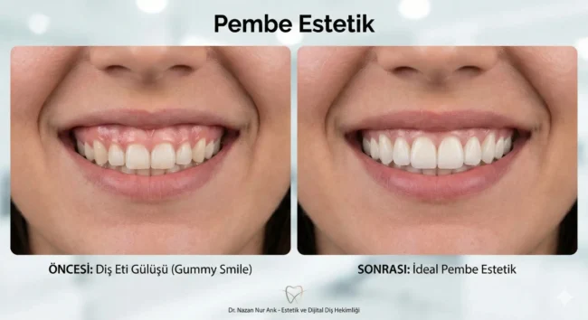 pembe estetik diş eti görünümü gülüşünüzü nasıl değiştirir