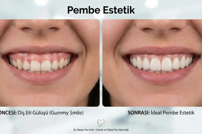 pembe estetik diş eti görünümü gülüşünüzü nasıl değiştirir