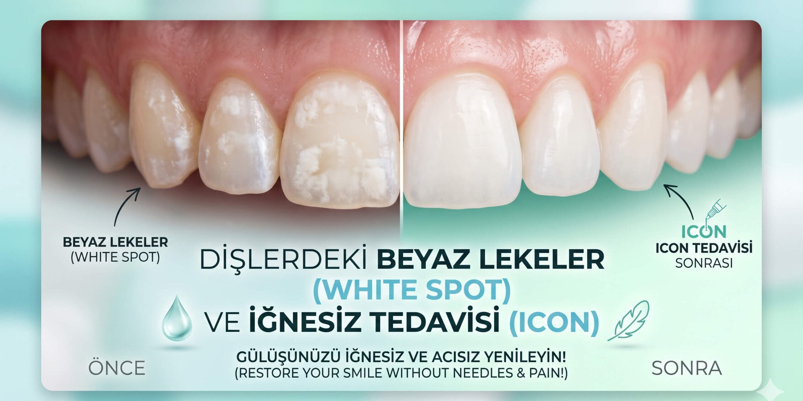 dişlerdeki beyaz lekeler, whit spot ve iğnesiz tedavi