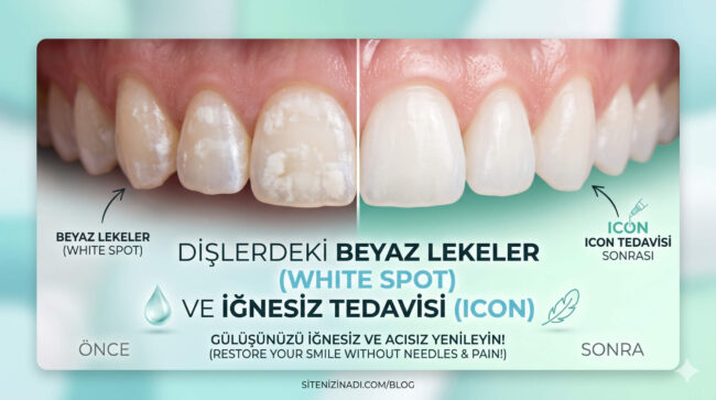 dişlerdeki beyaz lekeler, whit spot ve iğnesiz tedavi